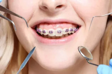 Orthodontic