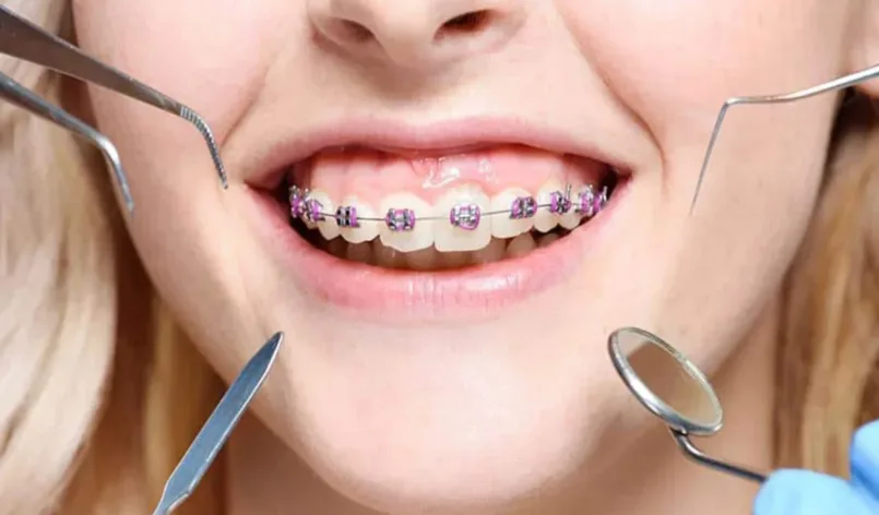 Orthodontic